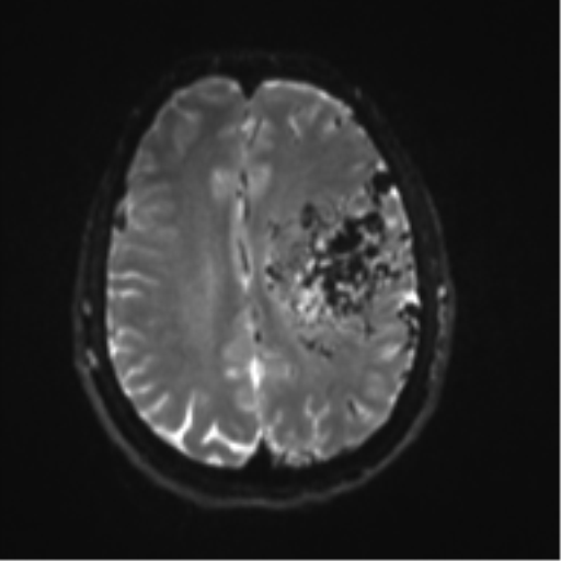 File:Cerebral arteriovenous malformation - huge (Radiopaedia 35734-37272 Axial DWI 16).png