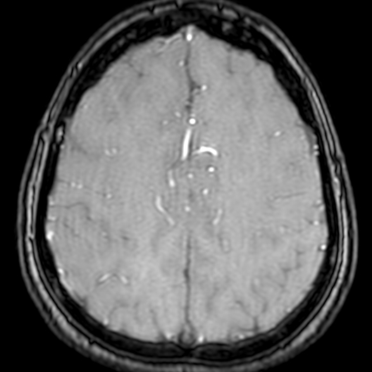 Cerebral arteriovenous malformation at posterior body of corpus callosum (Radiopaedia 74111-84925 Axial MRA 168).jpg