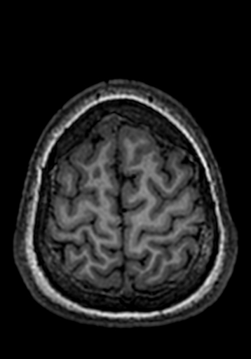 Cerebral arteriovenous malformation at posterior body of corpus callosum (Radiopaedia 74111-84925 Axial T1 29).jpg