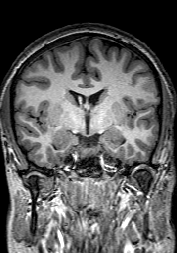Cerebral arteriovenous malformation at posterior body of corpus callosum (Radiopaedia 74111-84925 Coronal T1 146).jpg