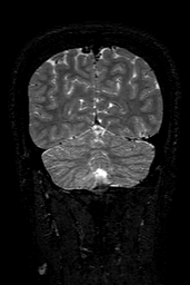 Cerebral arteriovenous malformation at posterior body of corpus callosum (Radiopaedia 74111-84925 Coronal T2 147).jpg
