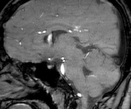 Cerebral arteriovenous malformation at posterior body of corpus callosum (Radiopaedia 74111-84925 J 183).jpg