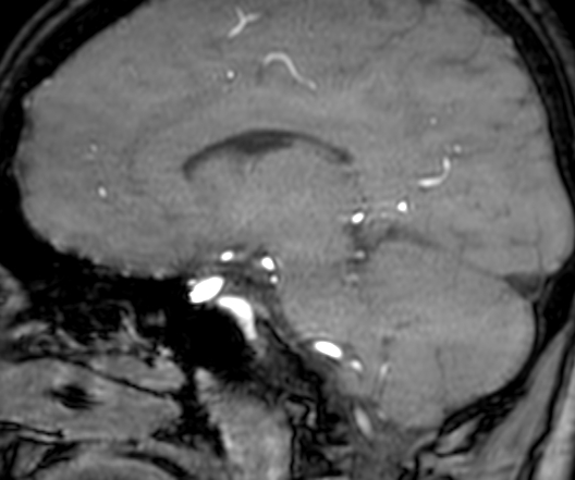 Cerebral arteriovenous malformation at posterior body of corpus callosum (Radiopaedia 74111-84925 J 222).jpg