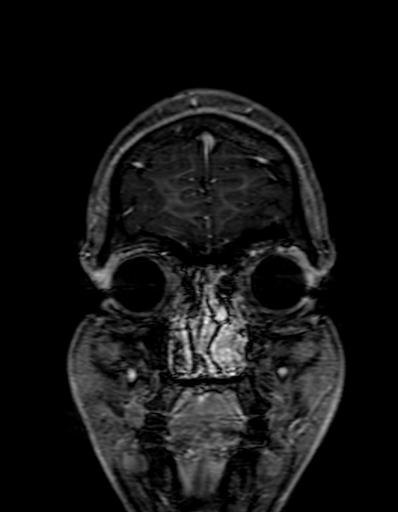 Cerebral arteriovenous malformation at posterior body of corpus callosum (Radiopaedia 74111-84925 K 22).jpg