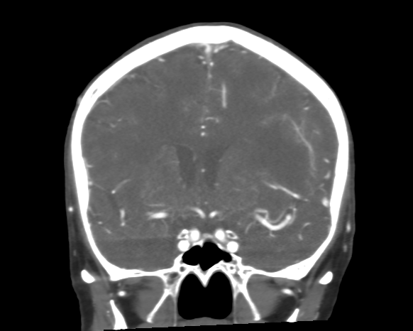 Cerebral arteriovenous malformation with lobar hemorrhage (Radiopaedia 44725-48511 A 25).png