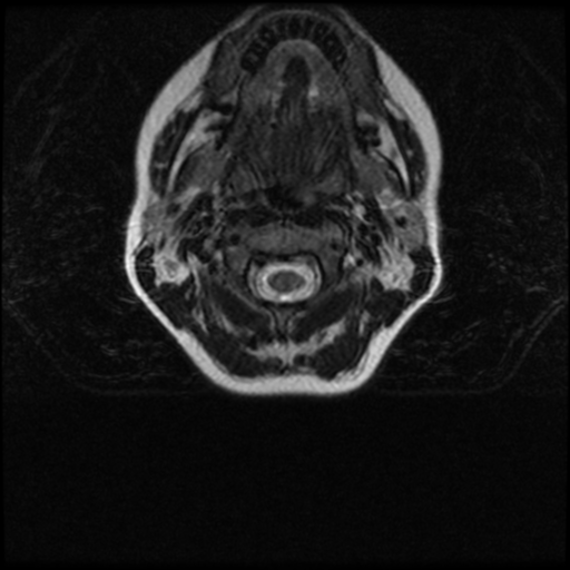 Cerebral autosomal dominant arteriopathy with subcortical infarcts and leukoencephalopathy (CADASIL) (Radiopaedia 41018-43763 Ax T2 C2-T1 4).png