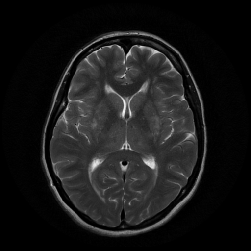 File:Cerebral autosomal dominant arteriopathy with subcortical infarcts and leukoencephalopathy (CADASIL) (Radiopaedia 41018-43768 Ax T2 PROP 11).png