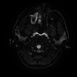 Cerebral cavernous venous malformation (Zabramski type II) (Radiopaedia 85511-101198 Axial DWI 3).jpg