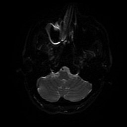 Cerebral cavernous venous malformation (Zabramski type II) (Radiopaedia 85511-101198 Axial DWI 73).jpg