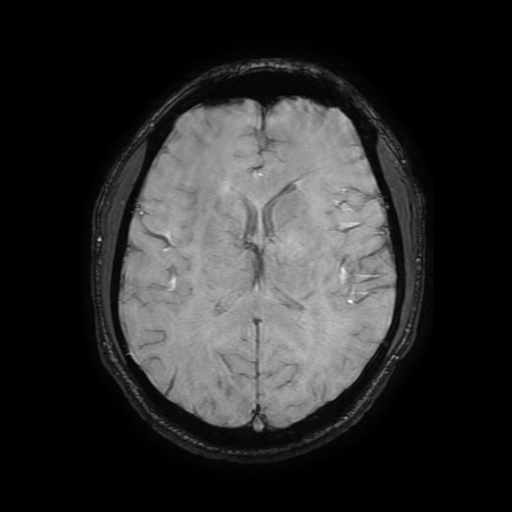 Cerebral cavernous venous malformation (Zabramski type II) (Radiopaedia 85511-101198 Axial SWI 72).jpg