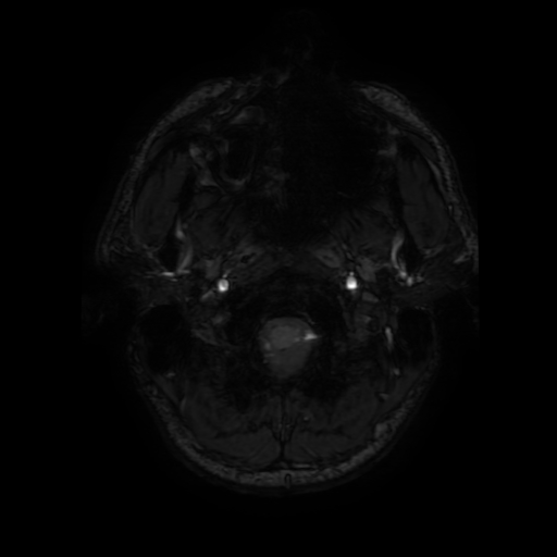 File:Cerebral cavernous venous malformation (Zabramski type II) (Radiopaedia 85511-101198 Axial SWI 9).jpg