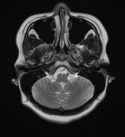 File:Cerebral cavernous venous malformations (Radiopaedia 48117-52946 Axial T2 4).png