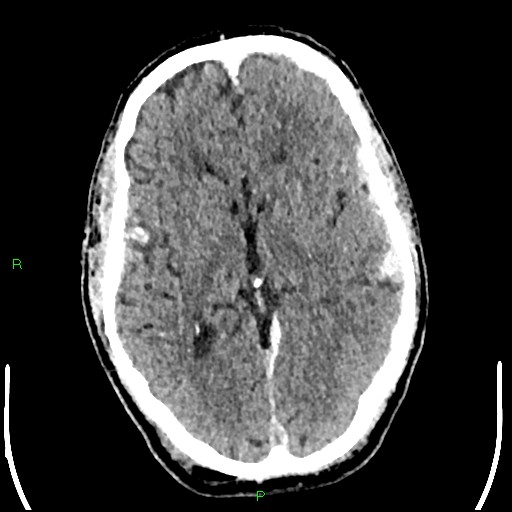 File:Cerebral contusions (Radiopaedia 33868-35039 Axial non-contrast 100).jpg