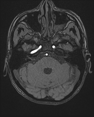 Cerebral embolic infarcts (embolic shower) (Radiopaedia 72391-82921 Axial MRA 27).jpg