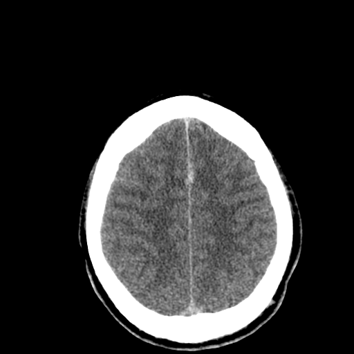 File:Cerebral hemorrhagic contusions- temporal evolution (Radiopaedia 40224-42753 Axial non-contrast 26).png