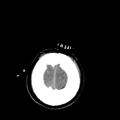 File:Cerebral hemorrhagic contusions- temporal evolution (Radiopaedia 40224-42755 AXIAL THICK 30).png