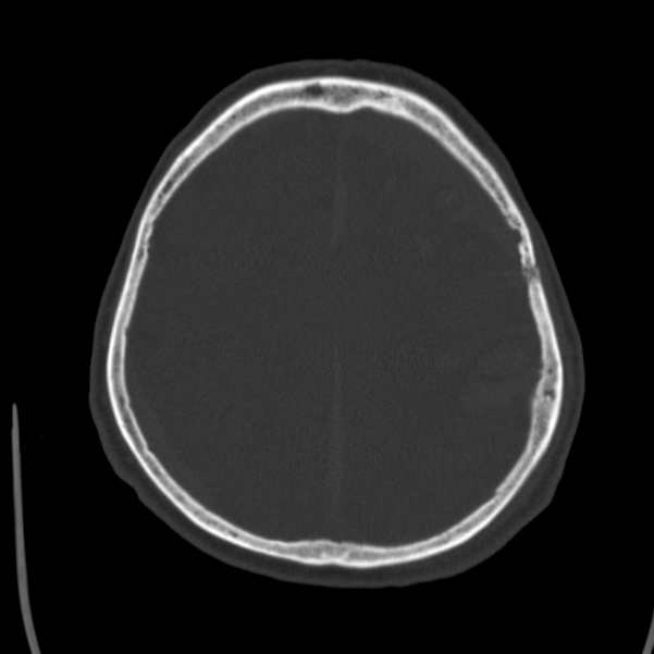 Cerebral hemorrhagic contusions (Radiopaedia 23145-23188 Axial bone window 42).jpg