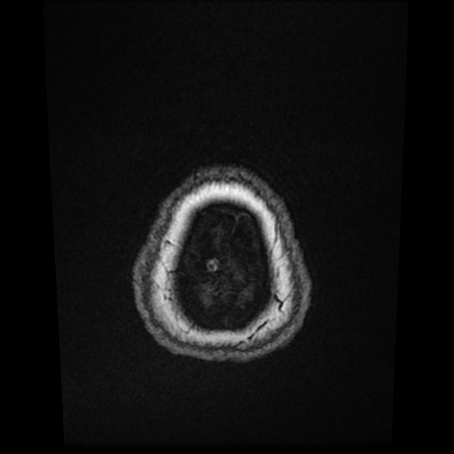 File:Cerebral metastases - melanoma (Radiopaedia 80972-94522 Axial T1 C+ 89).jpg