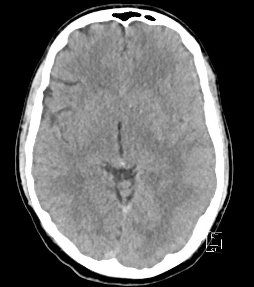 Cerebral metastases - testicular choriocarcinoma (Radiopaedia 84486-99855 Axial non-contrast 31).jpg