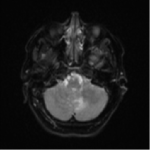 Cerebral metastases mimicking abscesses (Radiopaedia 45841-50131 Axial DWI 7).png