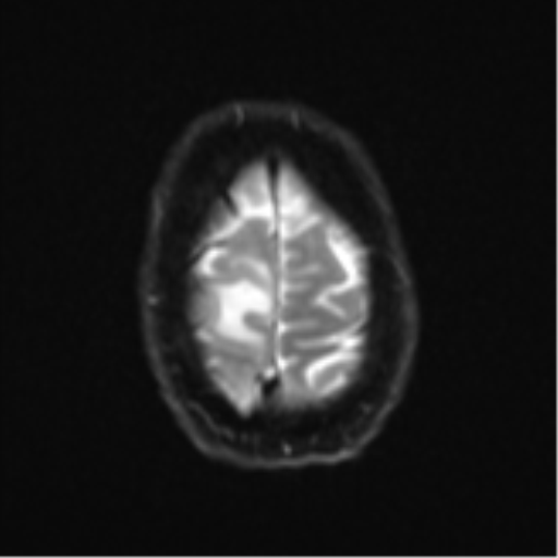 Cerebral metastasis - colorectal adenocarcinoma (Radiopaedia 50394-55765 Axial DWI 25).png