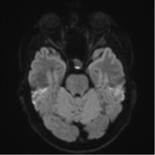 Cerebral metastasis - colorectal adenocarcinoma (Radiopaedia 50394-55765 Axial DWI 36).png