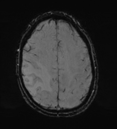 Cerebral metastasis - melanoma (Radiopaedia 54718-60954 Axial SWI 43).png