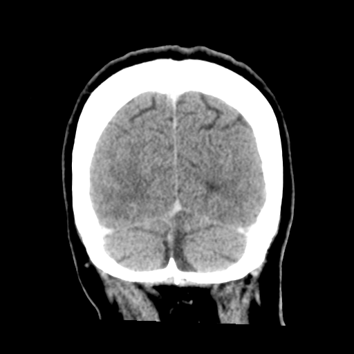 Cerebral metastasis to basal ganglia (Radiopaedia 81568-95412 Coronal C+ delayed 52).png