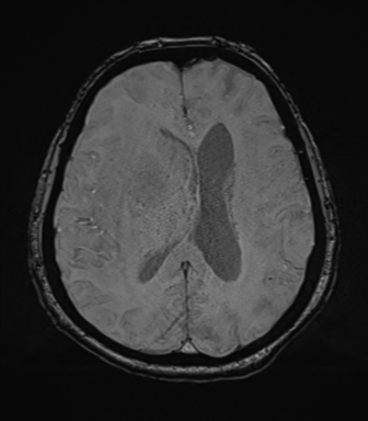 File:Cerebral metastasis to basal ganglia (Radiopaedia 81568-95413 Axial SWI 53).png