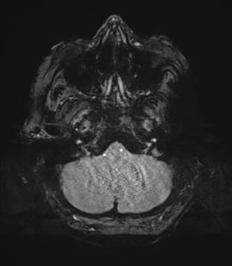 Cerebral metastasis to basal ganglia (Radiopaedia 81568-95413 Axial SWI magnitude 11).png