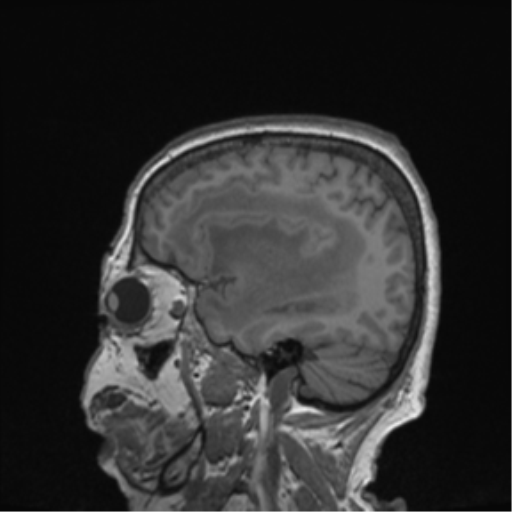 Cerebral metastasis to basal ganglia (Radiopaedia 81568-95413 Sagittal T1 58).png