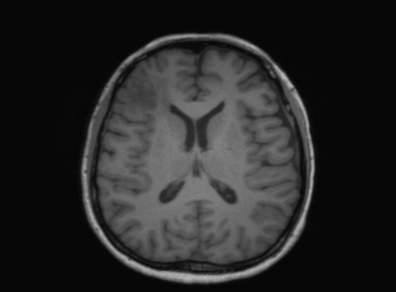 Cerebral ring enhancing lesions - cerebral metastases (Radiopaedia 44922-48817 Axial T1 208).jpg