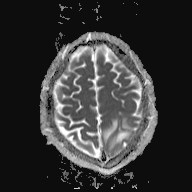 File:Cerebral toxoplasmosis (Radiopaedia 43956-47461 Axial ADC 17).jpg