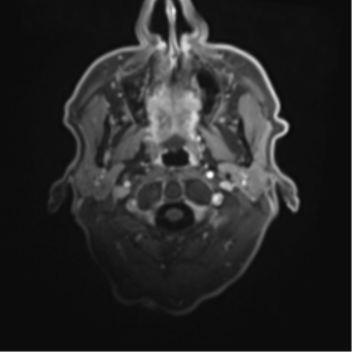 Cerebral toxoplasmosis (Radiopaedia 54575-60804 Axial T1 C+ 4).png