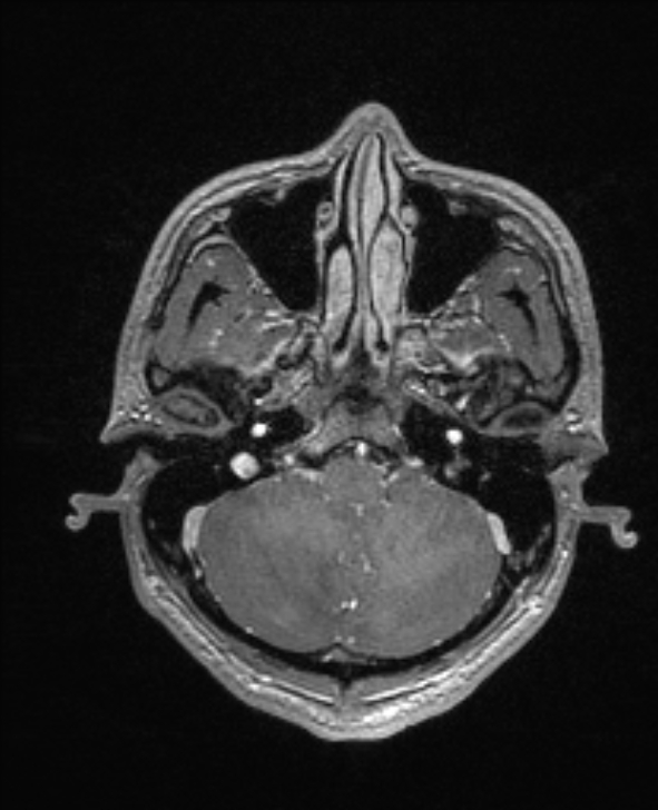 Cerebral toxoplasmosis (Radiopaedia 85779-101597 Axial T1 C+ 33).jpg