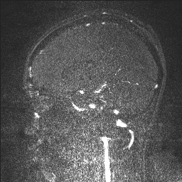 Cerebral tuberculosis with dural sinus invasion (Radiopaedia 60353-68090 Sagittal MRV 91).jpg