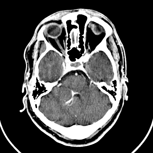 Cerebral venous angioma (Radiopaedia 69959-79977 B 16).jpg