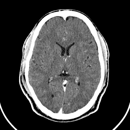 File:Cerebral venous angioma (Radiopaedia 69959-79977 B 50).jpg