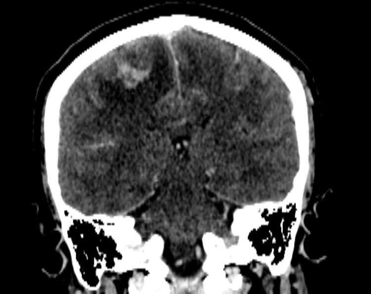 Cerebral venous hemorrhagic infarct from venous sinus thrombosis (Radiopaedia 55433-61883 Coronal C+ delayed 39).jpg