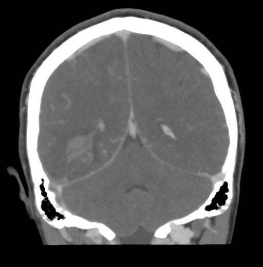 Cerebral venous hemorrhagic infarction (Radiopaedia 38461-40550 Coronal MIP VENOGRAM 42).png