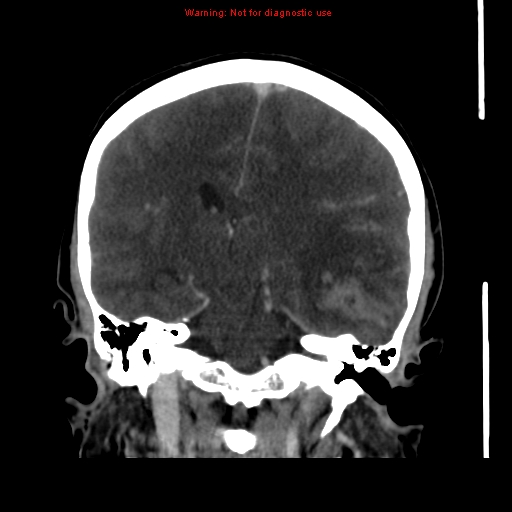 Cerebral venous infarction (Radiopaedia 12404-20735 B 46).jpg