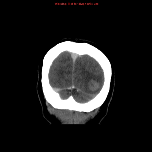 Cerebral venous infarction (Radiopaedia 12404-20735 B 76).jpg