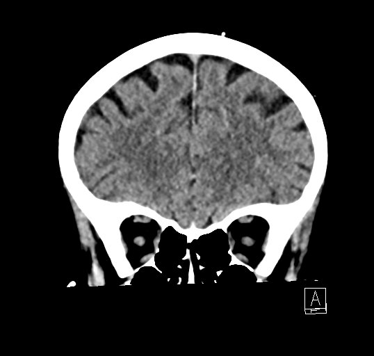 Cerebral venous infarction with hemorrhage (Radiopaedia 65343-74381 Coronal non-contrast 12).jpg