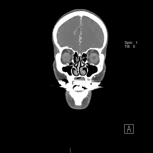 File:Cerebral venous infarction with hemorrhage (Radiopaedia 65343-74396 B 60).jpg