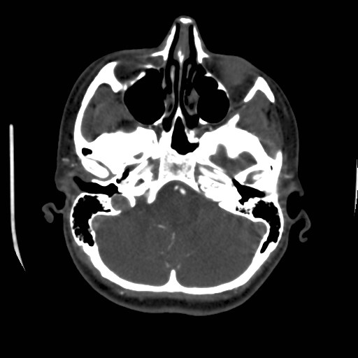 Cerebral venous sinus thrombosis (Radiopaedia 40619-43227 A 46).jpg