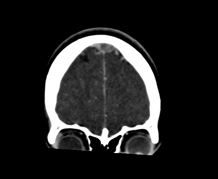 Cerebral venous sinus thrombosis (Radiopaedia 59224-66646 Coronal C+ delayed 8).jpg