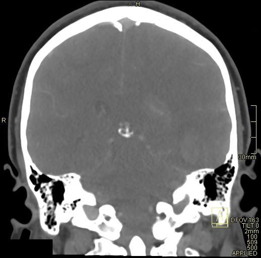 Cerebral venous sinus thrombosis (Radiopaedia 91329-108965 Coronal venogram 56).jpg