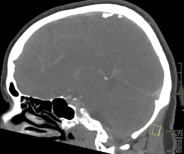 Cerebral venous sinus thrombosis (Radiopaedia 91329-108965 Sagittal venogram 35).jpg
