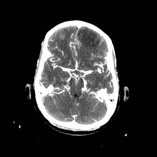 File:Cerebral venous throbmosis - hemorrhagic venous infarction (Radiopaedia 87318-103613 B 14).jpg
