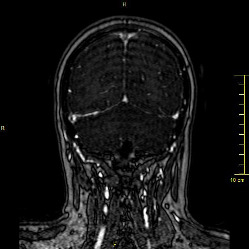 Cerebral venous thrombosis (Radiopaedia 23288-23351 MRV 134).JPG